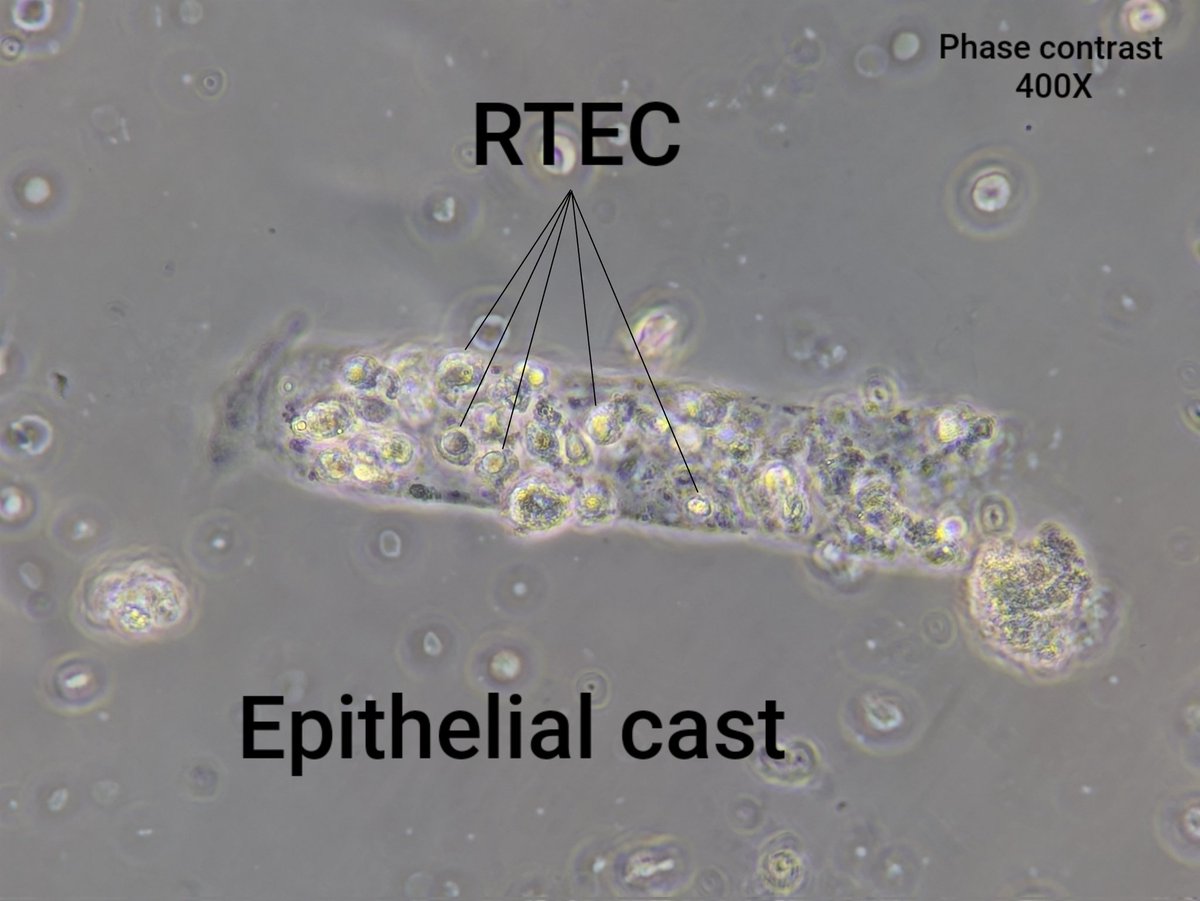 neph_ag's tweet photo. #UrinarySediment of patient with lupus nephritis and AKI.
#UrineMicroscopy https://t.co/PXz0599xgt