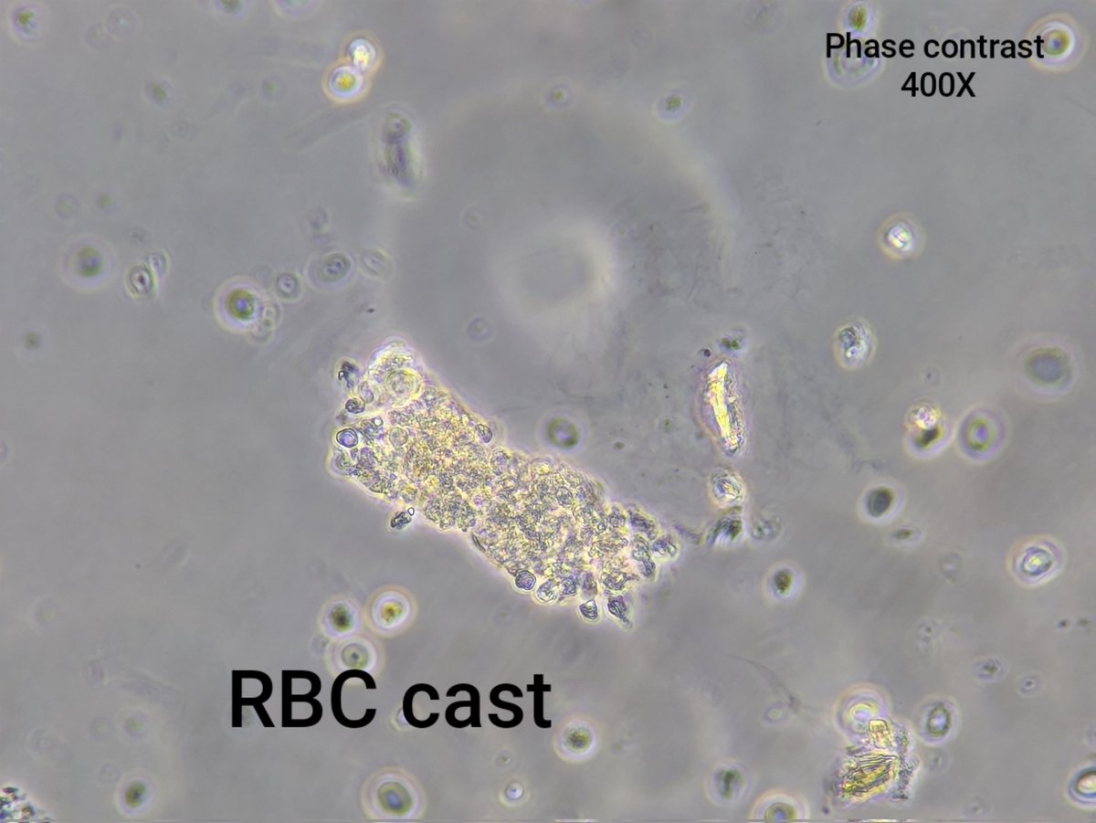neph_ag's tweet photo. #UrinarySediment of patient with lupus nephritis and AKI.
#UrineMicroscopy https://t.co/PXz0599xgt