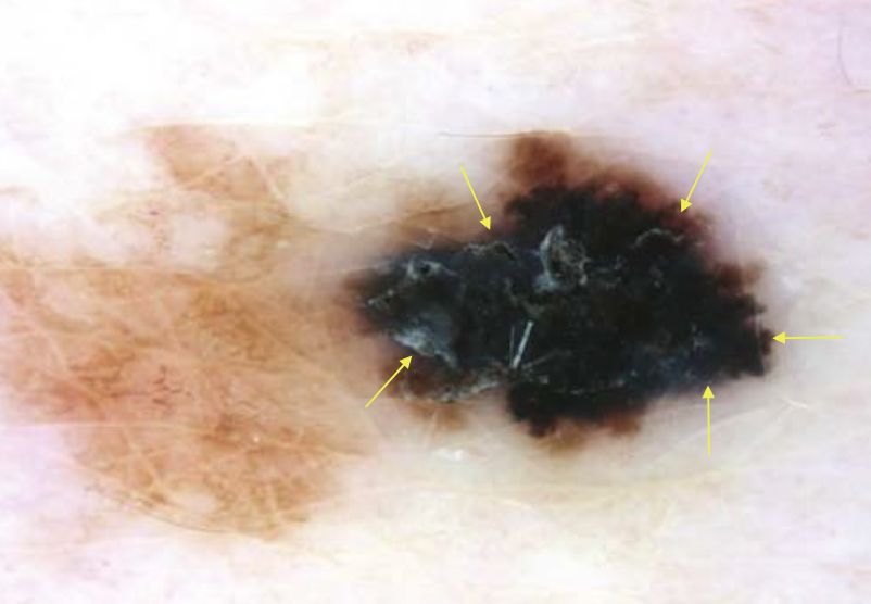 DermMarianne's tweet photo. 1⃣ Dermoscopic structure a day
⚫️Irregular Blotch
• Dark shades of black, brown or gray structureless areas of color
• Irregular in size & shape
• Seen in melanoma
#dailyscope https://t.co/pfq197izmN