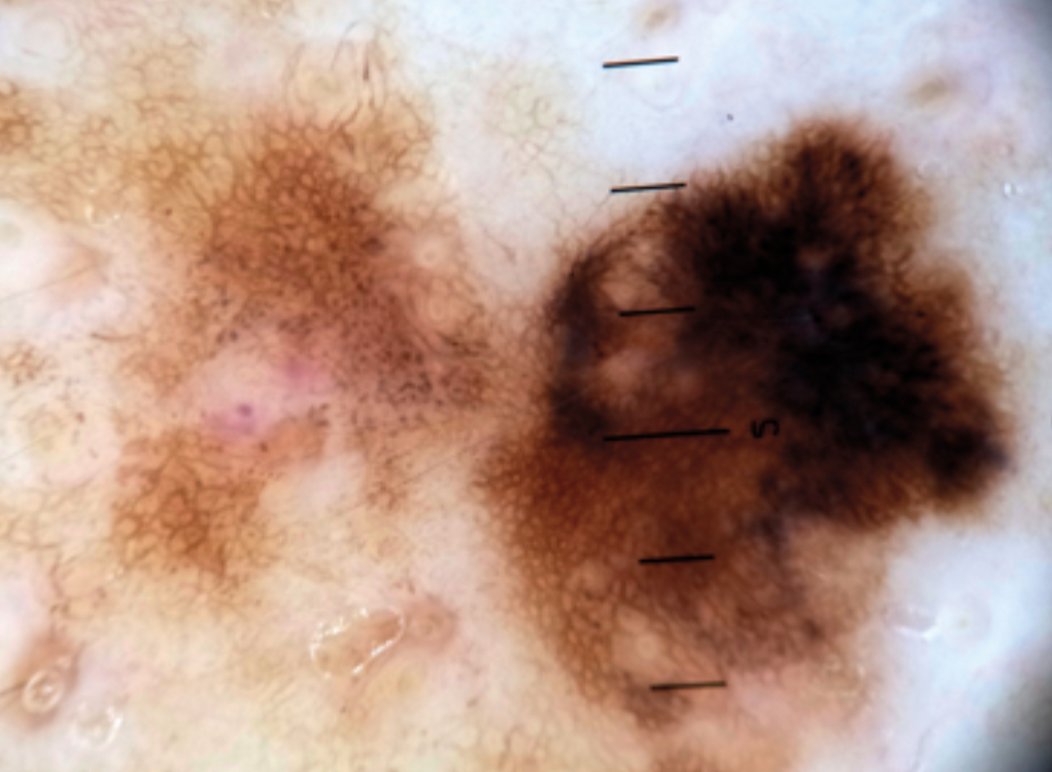 DermMarianne's tweet photo. 1⃣ Dermoscopic structure a day
⚫️Irregular Blotch
• Dark shades of black, brown or gray structureless areas of color
• Irregular in size & shape
• Seen in melanoma
#dailyscope https://t.co/pfq197izmN