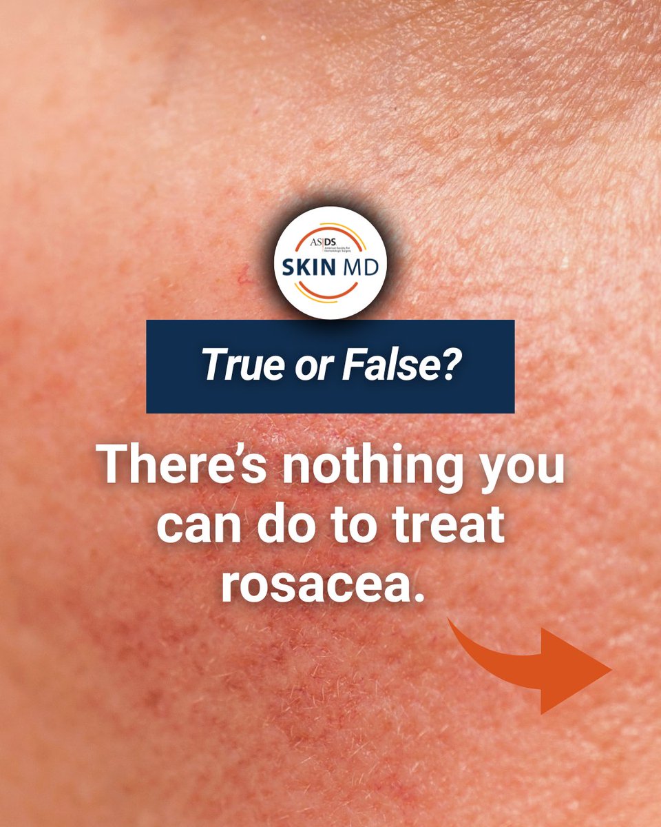 ASDSSkinMD's tweet photo. There are more effective treatments for rosacea than ever before. From topicals to laser therapies, today’s options can significantly help reduce redness and breakouts
 
#ASDSSkinMD #RoscaeaAwarenessMonth https://t.co/HwP76MOsHs