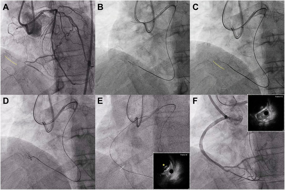 CJCJournals's tweet photo. 🤔 Can't penetrate an occluded stent from retrograde? Use the retrograde scratch-and-go technique to go around it and solve the problem! ⬇️
https://t.co/urtvGIrF7e
@UWMedHeart #CJC https://t.co/8Xj8bPo2xK