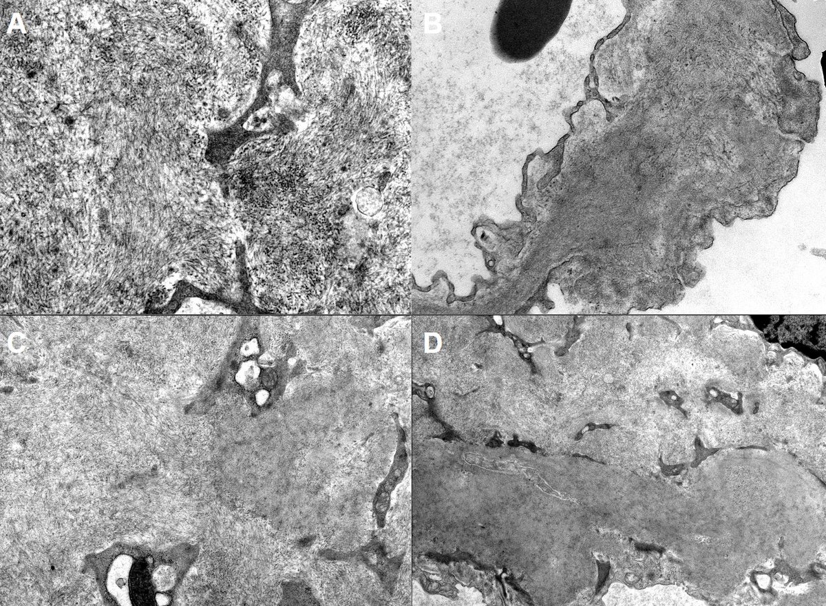 JZRenalPath's tweet photo. Fibrillary or amyloid? How about both! Concurrence of ALECT amyloidosis and DNAJB9+ FGN. EM shows admixed but distinct fibril population. Mass spec was required for definitive diagnosis. https://t.co/EDRfRQsLel  #renalpath #nephrology #pathtwitter https://t.co/I25JZflhJz
