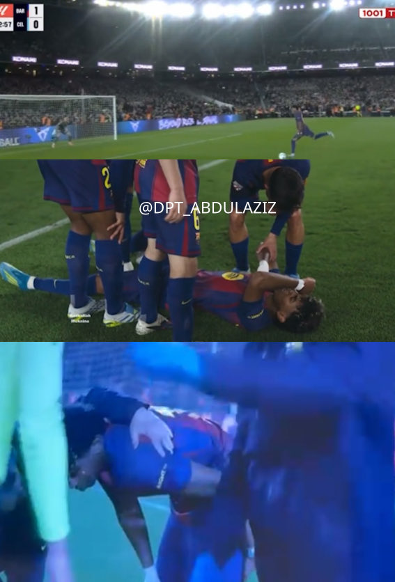 DPT_ABDULAZIZ's tweet photo. إصابة لامين يامال لاعب نادي برشلونة 

من طريقة انزعاج اللاعب كونه حس بالانزعاج بعد التسديد والاحتفال فإنها عضلية , ميكانيكية التسديد تشير إلى العضلة الضامة ولكن بناءً على شكوى اللاعب فالأقرب أنها إصابة على مستوى العضلة الخلفية للفخذ 

إذا ثبت ذلك فمدة الغياب 

٢-٤ أسابيع تمزق من الدرجة الأولى 
٥-٨ أسابيع تمزق من الدرجة الثانية 

بانتظار المزيد من الفحوصات الطب��ة لتأكد من نوع وشدة الإصابة 

باذن الله تعدي سلامات ✊🏻