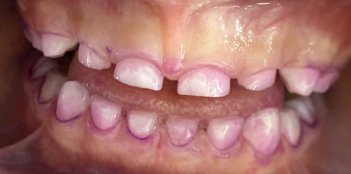 clarabolism's tweet photo. 🦷 ¿Crees que cepillas bien? ¡El revelador de placa no miente!
Esta tinción violeta muestra exactamente dónde se acumula la placa bacteriana -las zonas que el cepillo no está alcanzando.
La profilaxis dental profesional es clave: limpia lo que en casa no puedes ver ni eliminar. https://t.co/gbmpLA3Qyp