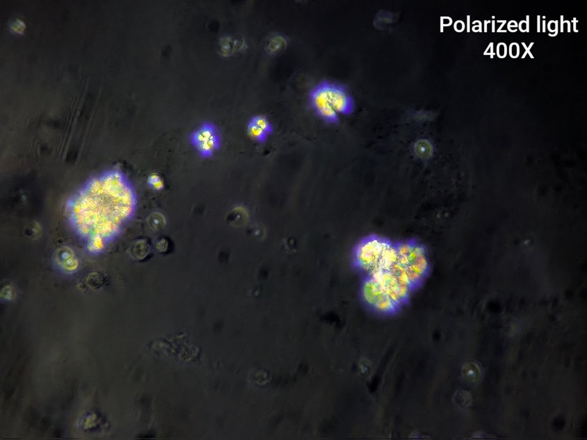 neph_ag's tweet photo. #UrinarySediment #UrineMicroscopy A cast containing monohydrated calcium oxalate crystals https://t.co/Qugbmoytn4