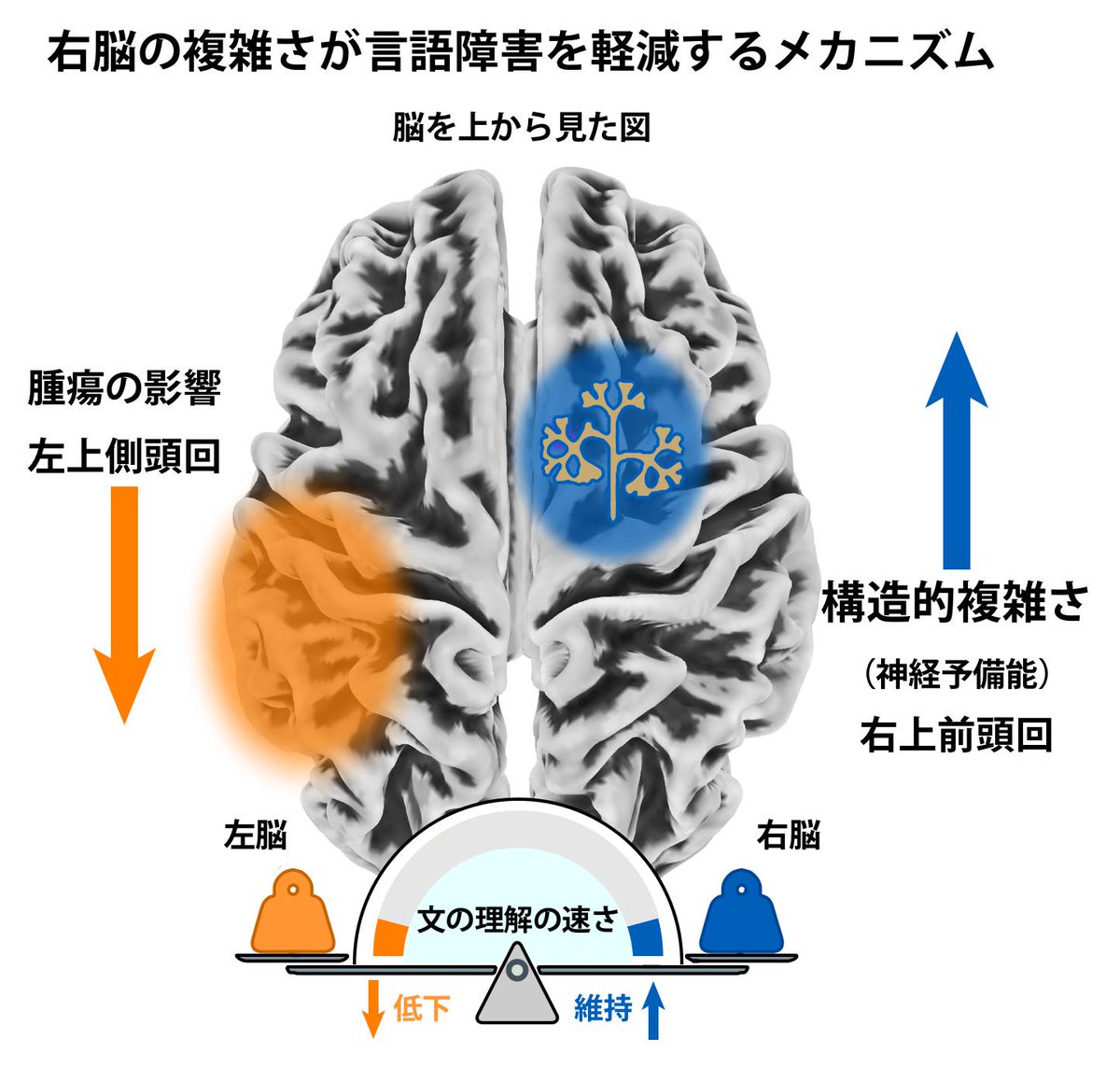 【📢プレスリリース】左脳の脳腫瘍による言語障害の個人差を解明
昭和医科大学の金野竜太准教授らの共同研究グループは、脳腫瘍患者において、左半球の言語関連領域が影響を受けた場合でも、右半球の構造的特徴が言語処理速度の個人差に関与する可能性を明らかにしました。

showa-u.ac.jp/news/nid000087…