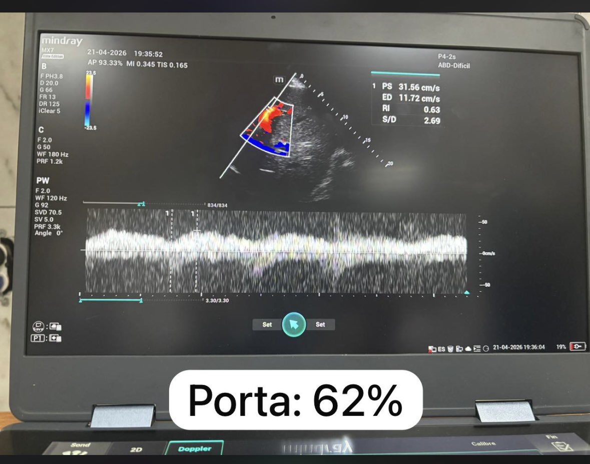DrCriticalCare's tweet photo. Guiando TRRC en descongestión por Ecocardiografia de Cuidados Críticos 
Relación E/A: 2.5 
Relación E/é: 32.6
Presión capilar pulmonar estimada por Nagueh: 32 mmHg 
Porta: 62% 
LUS score : 25
#UTIC #TRRC #ECOCRITICO https://t.co/XNmnuMGU9A