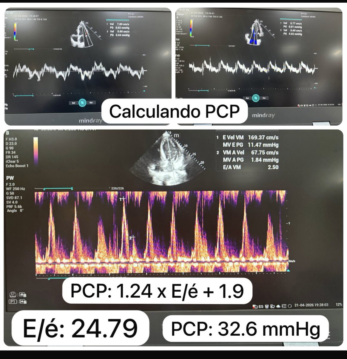 DrCriticalCare's tweet photo. Guiando TRRC en descongestión por Ecocardiografia de Cuidados Críticos 
Relación E/A: 2.5 
Relación E/é: 32.6
Presión capilar pulmonar estimada por Nagueh: 32 mmHg 
Porta: 62% 
LUS score : 25
#UTIC #TRRC #ECOCRITICO https://t.co/XNmnuMGU9A