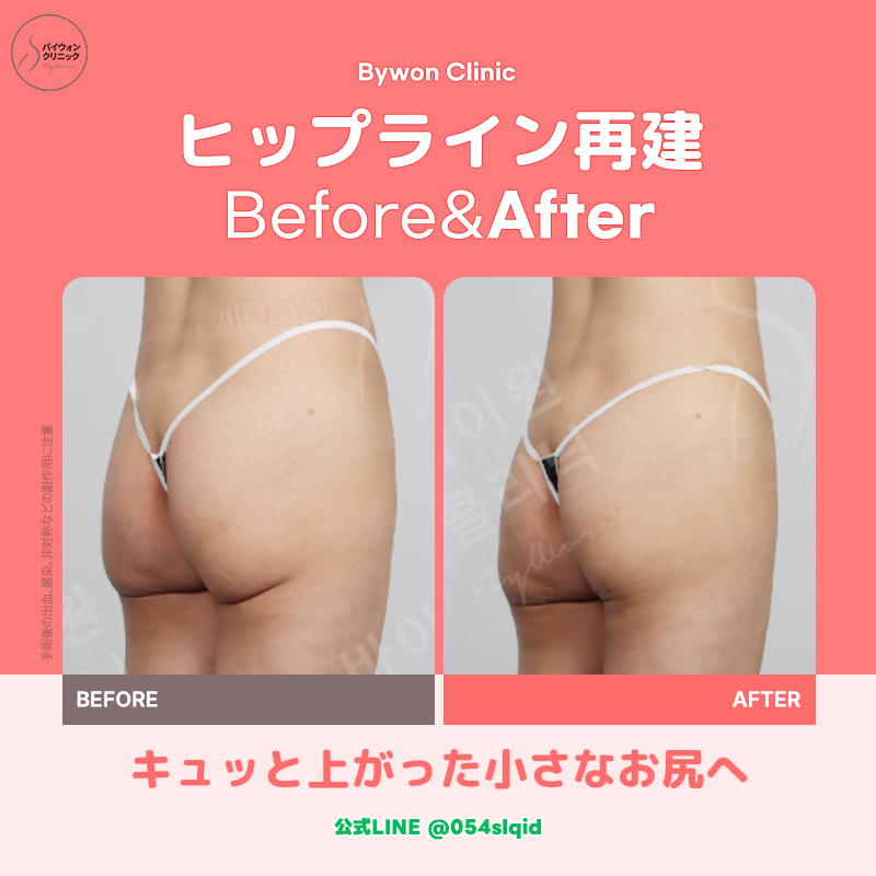 【韓国脂肪吸引専門】バイウォンクリニック tweet media