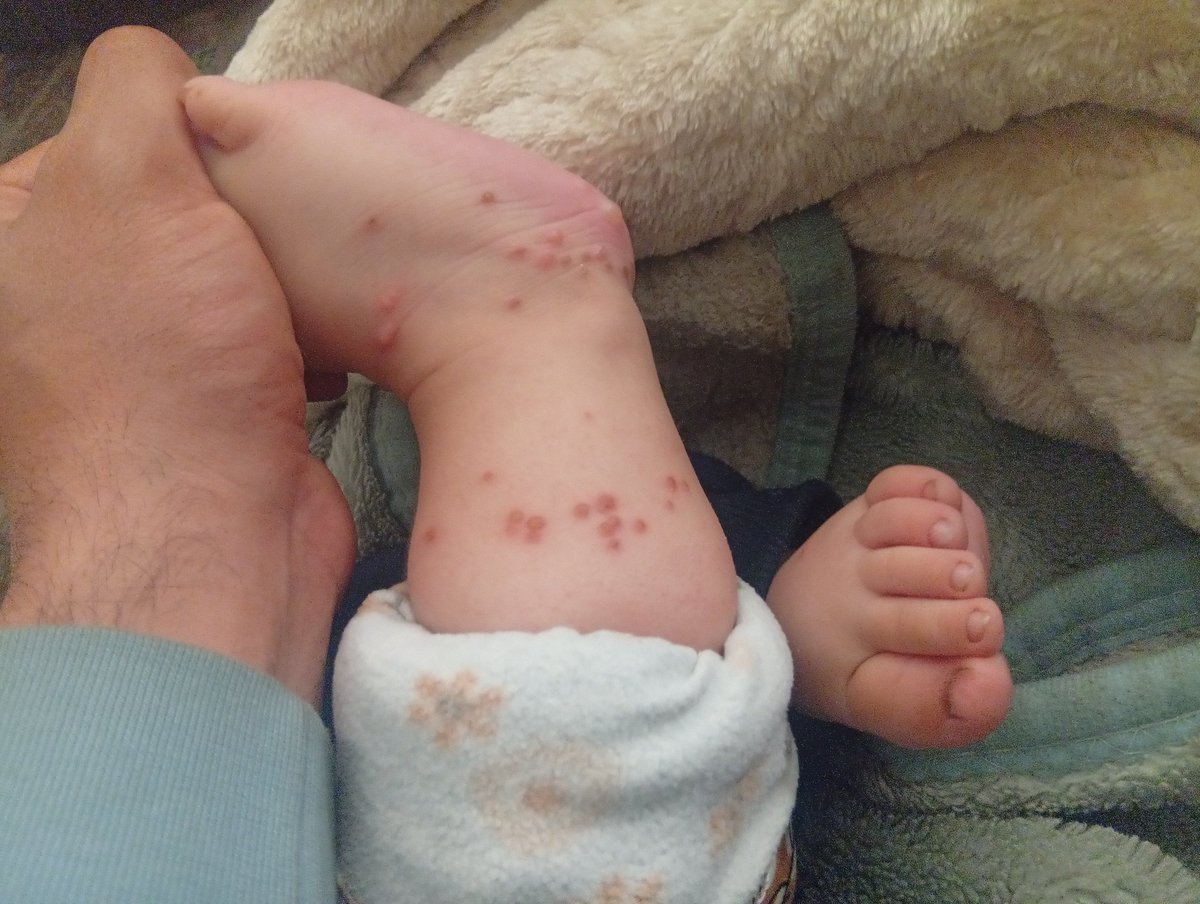 nizar_almasre's tweet photo. My brother Eid Bashir's leg is full of seeds due to very strange and harmful insects. https://t.co/RZlmznWiN2