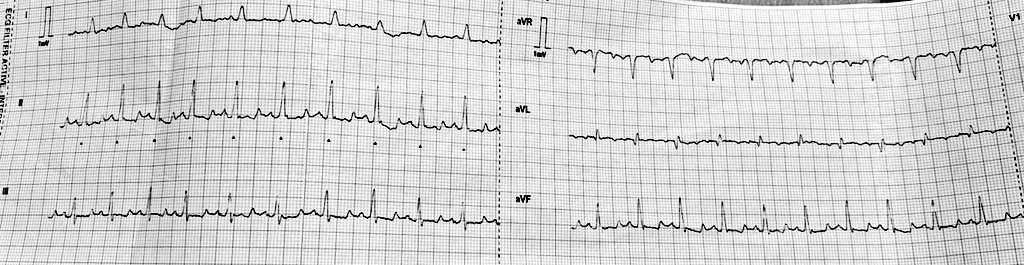 OnlyEcg1's tweet image. Old man with low BP. Thoughts?

 #MedicalEmergency #cardiovascular #cardiologist #MedicalEducation #EKG #ECG #Paramedics #medicalstudent #MedTwitter #CardioTwitter #Cardiology #CardioEd #MedicalCase #MedicalQuiz