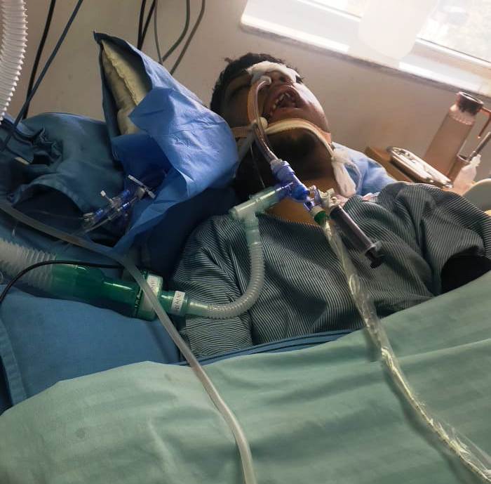 झारखंड का एक 10 वर्षीय बच्चा, मोहम्मद अली खान, जो 90% दिव्यांग है, सड़क हादसे के बाद जिंदगी और मौत से जूझ रहा है। उसका एक फेफड़ा पूरी तरह खराब हो चुका है। सरकारी अस्पतालों ने सुविधा के अभाव में हाथ खड़े कर दिए हैं और निजी अस्पताल का खर्च परिवार उठा नहीं पा रहा।

इस हादसे में उनके