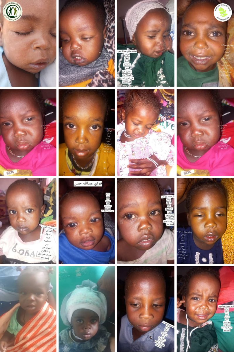 DVSorg's tweet image. منظمة مناصرة ضحايا دارفور 
منظمة الأمل والملاذ للاجئين

📍 ولاية شمال دارفور – محلية الكبكابية
📅 22 أبريل 2026

🔴 بيان مناشدة عاجلة

#تقرير_ميداني

تشهد محلية الكبكابية أوضاعًا صحية بالغة الخطورة نتيجة تفشي مرض الحصبة والسعال الديكي بشكل واسع في المدينة وضواحيها والقرى والفرقان