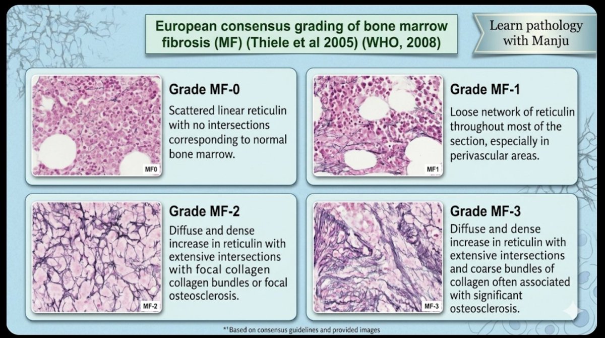 ManjulaNavamani's tweet image. #heamtology
#pathresidents
#pathtwitter #pathx 
#specialstains 
#bonemarrow 
#learnpathologywithmanju 
Learn pathology with funnn!!! as well
Reticulin and grading bone marrow fibrosis...
@MunchManju95