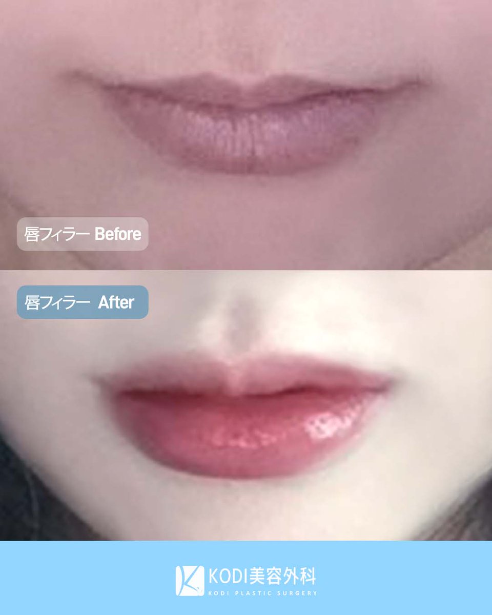 KODI美容外科💖江南でフィラーするならコディ💖 tweet media