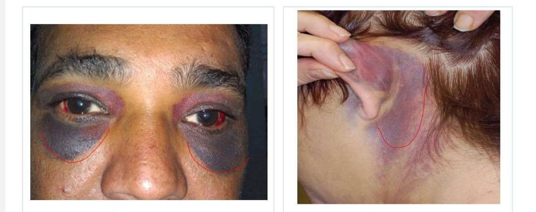 suhail_nasim's tweet image. A patient presents with periorbital ecchymosis and retroauricular bruising post RTA …
Name these two classic signs..
what LIFE-THREATENING injury could be hiding underneath?

#trauma #headinjury