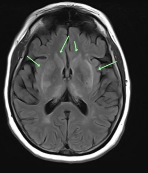 psycheureka's tweet photo. Some cases of “treatment-resistant depression” aren’t just psychiatric.

They may have an important vascular component.

And one ‘clue’ can be seen on MRI:

white matter hyperintensities (WMHs) 🧵👇 https://t.co/m7gPcPQPbB