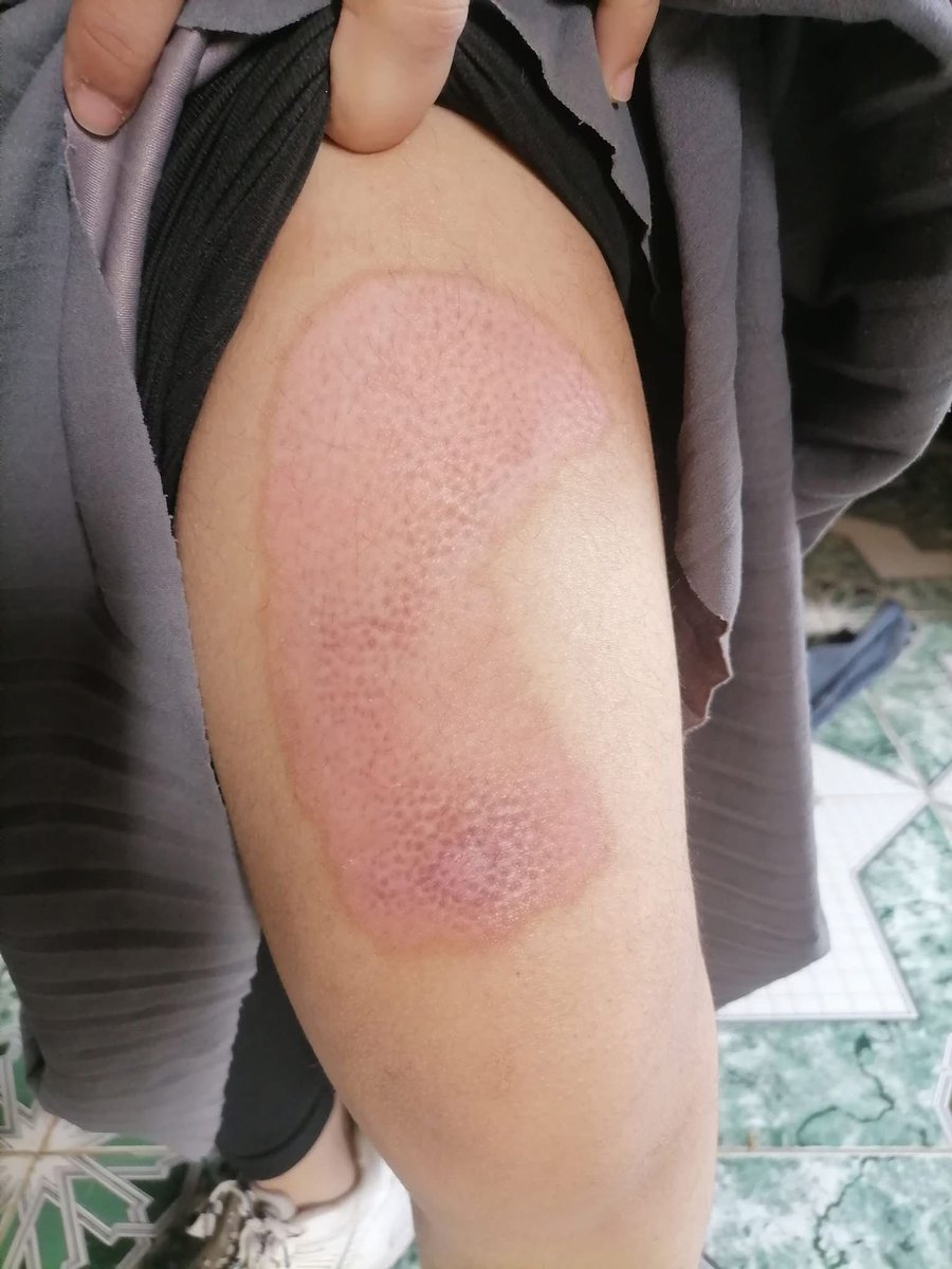 Dr_SaebGaza's tweet image. This thing appeared on my child's foot And it is increasing significantly 
 Pray for my child 😭

gofund.me/62fb9062d