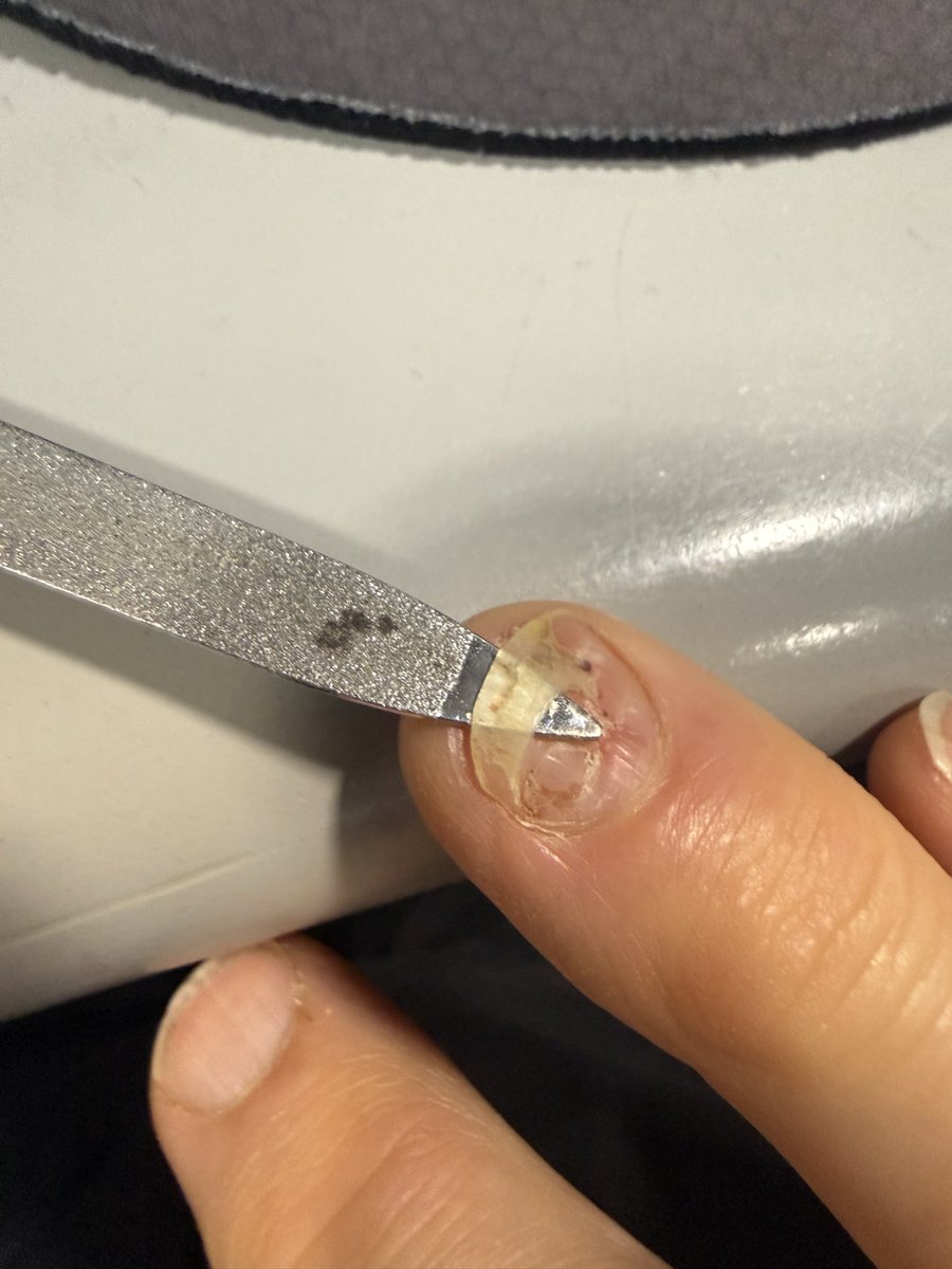 Losing a nail is so weird.