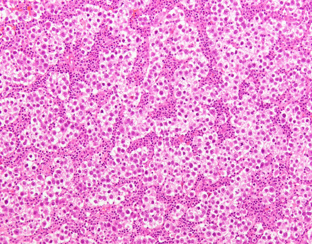 DrCycloPath's tweet image. #PathQuiz 🔬🧬 #GynPath
19-year-old female with hypercalcemia + pelvic mass.

A) Ovarian Clear Cell Carcinoma
B) Dysgerminoma
C) Mesonephric-like Adenocarcinoma
D) Small Cell Carcinoma, Hypercalcemic Type

#Pathology #GynPath