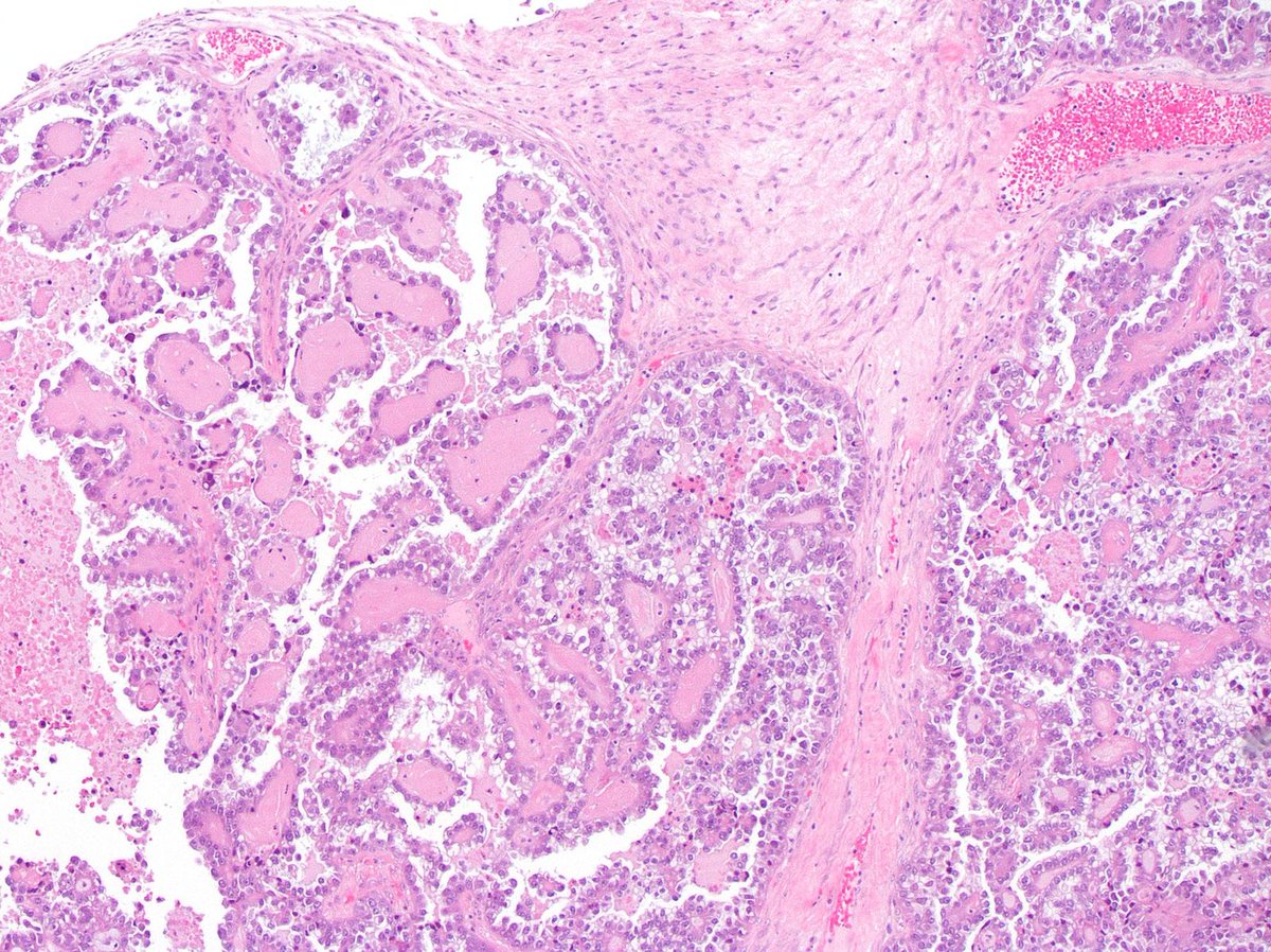 DrCycloPath's tweet image. #PathQuiz 🔬🧬 #GynPath

A) Ovarian Clear Cell Carcinoma
B) Endometrioid Carcinoma
C) Yolk Sac Tumor
D) Dysgerminoma

#Pathology #GynPath