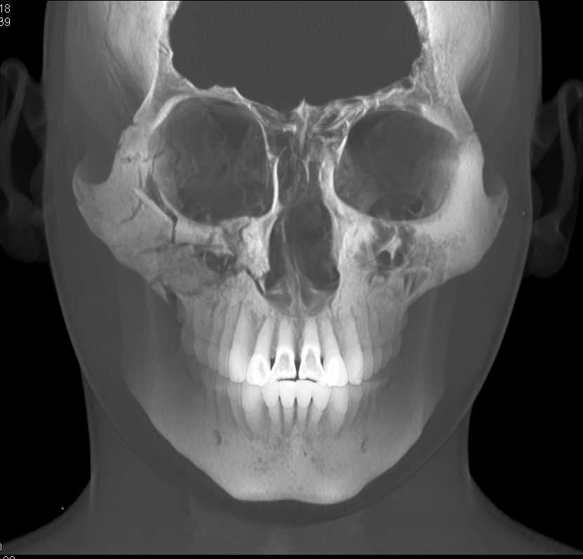 bwells80's tweet image. #RT @ctisus: Right Orbital Fracture: ctisus.com/teachingfiles/…