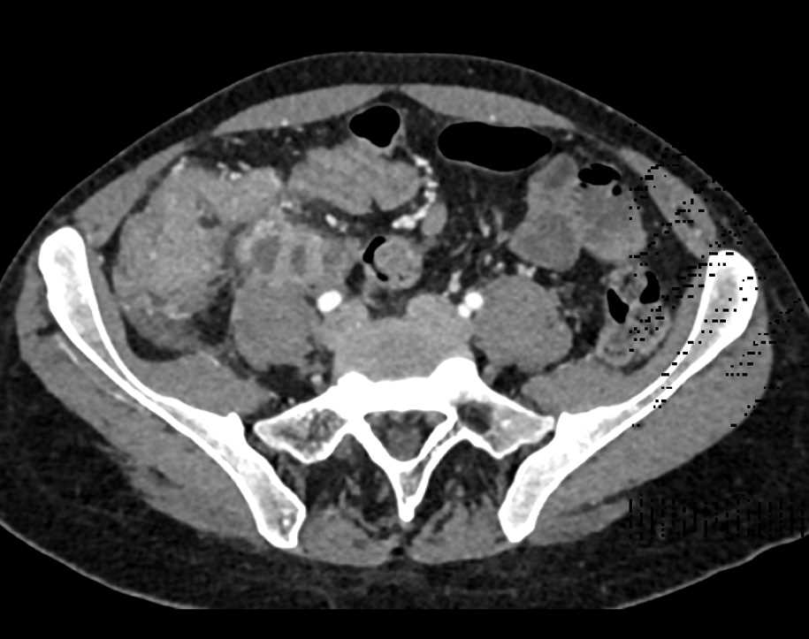 bwells80's tweet image. #RT @ctisus: Salmonella Infection of Terminal Ileum and Cecum: ctisus.com/teachingfiles/…