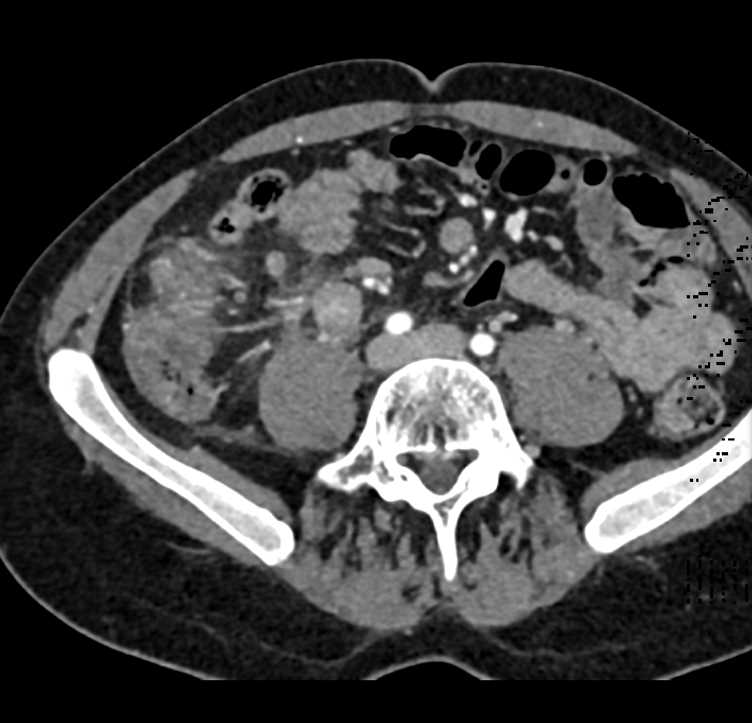 bwells80's tweet image. #RT @ctisus: Salmonella Infection of Terminal Ileum and Cecum: ctisus.com/teachingfiles/…