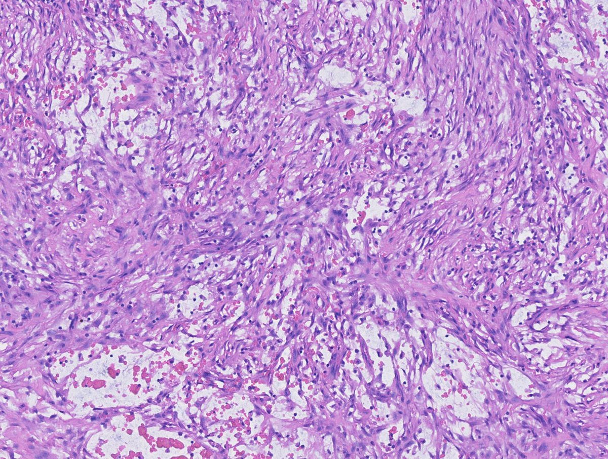 DrCycloPath's tweet image. #PathQuiz 🔬🧬 #SoftTissuePath

A) Desmoid Fibromatosis
B) Proliferative Fasciitis
C) Myositis Ossificans
D) Nodular Fasciitis

#Pathology #SoftTissuePath #DermPath