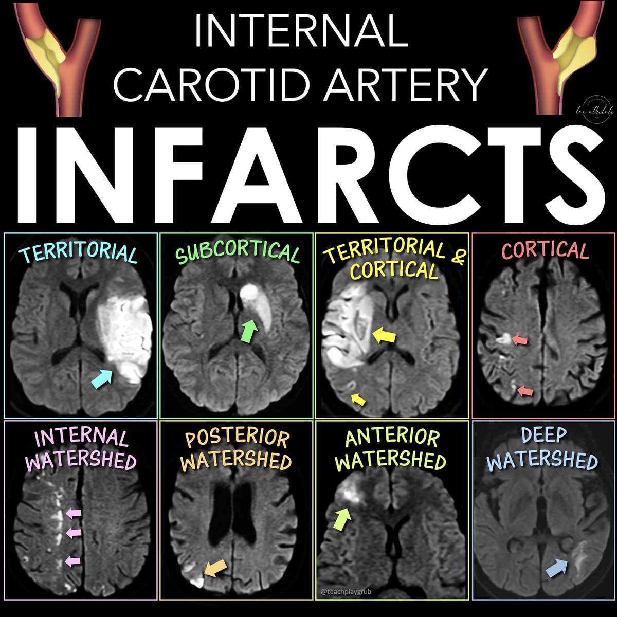 Can you get the diagnosis when it comes to carotid stenosis?
 
Having some confusion about the strokes you see w/ICA occlusion?
 
Why are there so many different patterns of infarcts w/ICA occlusion/stenosis?
 
There are 5 main infarct patterns—and they reflect the different