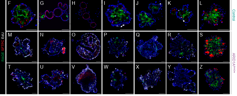 LabWaggoner's tweet photo. BAF complex activity is requried during lung epithelial development &amp; reveals differential specificity between signaling pathways 
https://t.co/fFSY7I5TEr
@CincyKidsNeo @CincyResearch @HyunwookLee18
@UCincyMedicine @CincyMSTP @MDBCincy
@DrWillZacharias @NatureComms https://t.co/pyaWvAIH32