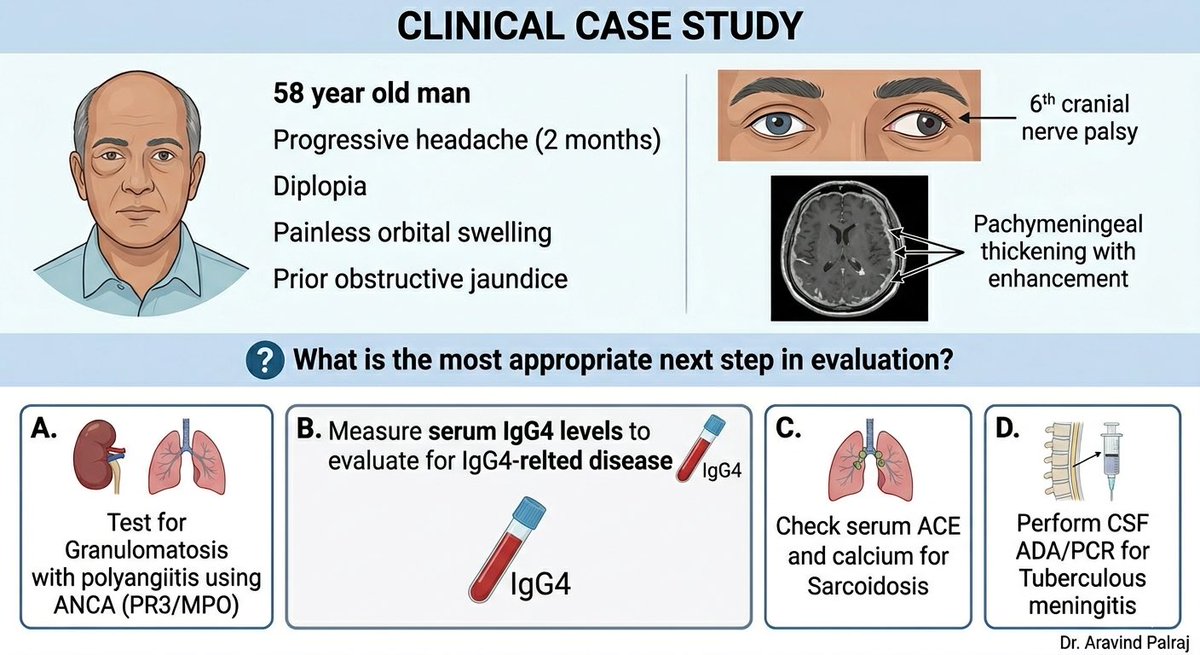 Rheumat_Aravind's tweet image. 🧠 Clinical MCQ

58M: headache + diplopia + orbital swelling + past obstructive jaundice

MRI → pachymeningitis

Next best step?

A ANCA
B Serum IgG4
C ACE/Ca
D CSF ADA

👇

🧠 Clinical MCQ

58M: headache + diplopia + orbital swelling + past obstructive jaundice

MRI →