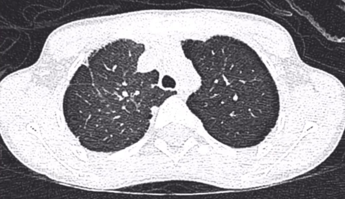 khaledzeid's tweet photo. Case Answer 🫁

The key to this case is pattern recognition.

👉 The HRCT shows a single-row, paraseptal emphysema–like appearance along the pleural surfaces and interlobar fissures.
In the pediatric age group, this corresponds to what is described in the literature as subpleural lung cysts (SLCs).

Important distinction:

This is not immediate subpleural sparing

Rather, it is true subpleural involvement with cystic lucencies aligned along pleura and fissures
How does this guide the differential?

Once correctly recognized as SLCs:

🔹 The differential narrows toward:

Developmental / alveolar growth abnormalities

🔹 A key alternative consideration:

Ventilation-related interstitial emphysema
Typically occurs in patients with a history of mechanical ventilation
Often shows air dissecting along bronchovascular bundles in addition to peripheral cysts

📌 In this case:

The pattern is confined to subpleural regions and fissures

There is no peribronchovascular air dissection, making ventilator-induced interstitial emphysema less likely

What this pattern is NOT:

Recognizing SLCs helps avoid misclassification as:

Pulmonary Langerhans cell histiocytosis
Lymphangioleiomyomatosis
Lymphoid Interstitial Pneumonia

These entities show different cyst morphology, distribution, and clinical context, and are not appropriate fits in this pediatric scenario.

Clinical correlation

This imaging pattern is well recognized in children with Down syndrome, likely reflecting abnormal alveolar development. It may also be associated with congenital heart disease (e.g., endocardial cushion defects), supporting a developmental origin.
Similar-appearing peripheral lucencies can occasionally be encountered in prematurity/bronchopulmonary dysplasia, but the clinical context and overall imaging pattern differ.

Final diagnosis:
👉 Subpleural lung cysts in a child with Down syndrome (trisomy 21)

Take-home message 💡

Correctly identifying the paraseptal emphysema–like pattern as SLCs is the pivot point:

It shifts the interpretation away from diffuse cystic lung diseases

And directs attention toward developmental lung abnormalities in pediatric patients
A subtle but powerful example of how distribution + morphology = diagnosis.

#HRCT #ChestRadiology #PediatricRadiology #DownSyndrome #RadiologyTeaching