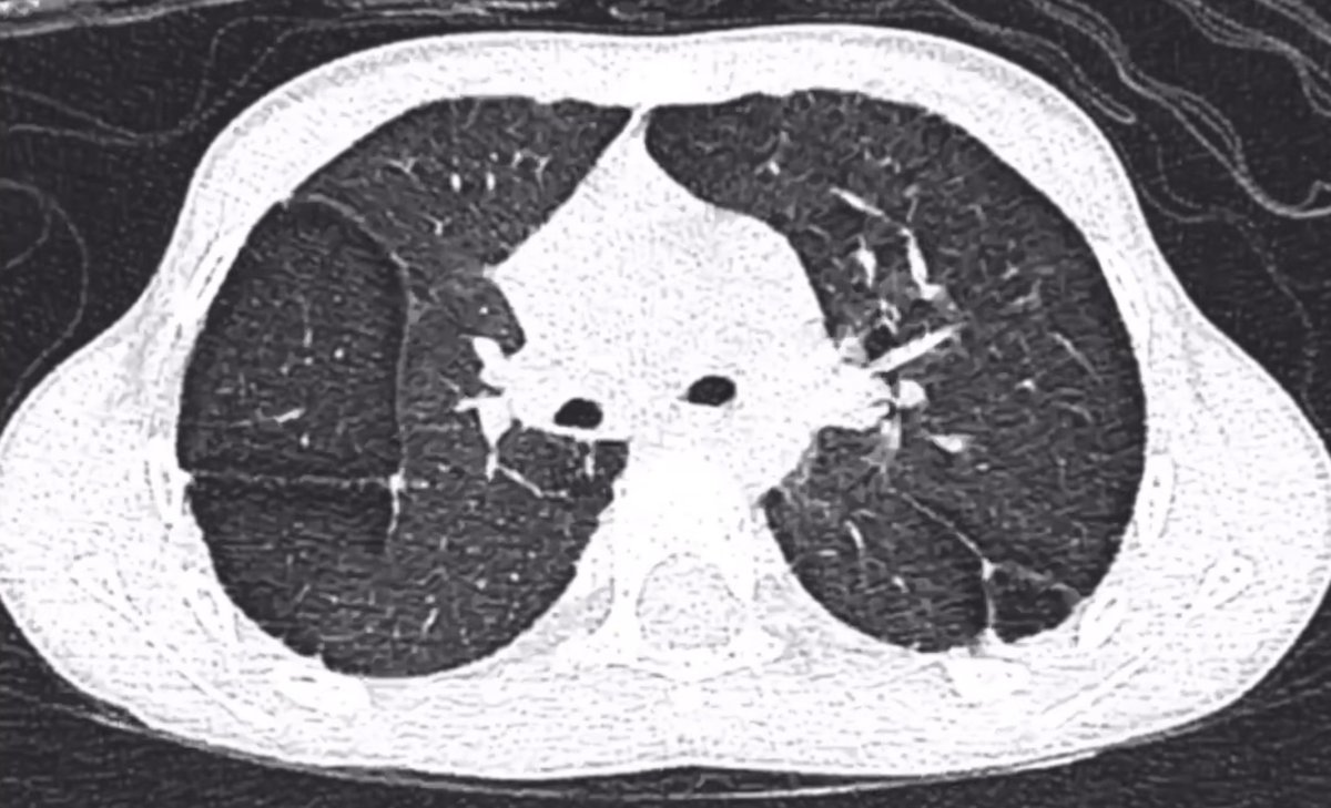 khaledzeid's tweet photo. Case Answer 🫁

The key to this case is pattern recognition.

👉 The HRCT shows a single-row, paraseptal emphysema–like appearance along the pleural surfaces and interlobar fissures.
In the pediatric age group, this corresponds to what is described in the literature as subpleural lung cysts (SLCs).

Important distinction:

This is not immediate subpleural sparing

Rather, it is true subpleural involvement with cystic lucencies aligned along pleura and fissures
How does this guide the differential?

Once correctly recognized as SLCs:

🔹 The differential narrows toward:

Developmental / alveolar growth abnormalities

🔹 A key alternative consideration:

Ventilation-related interstitial emphysema
Typically occurs in patients with a history of mechanical ventilation
Often shows air dissecting along bronchovascular bundles in addition to peripheral cysts

📌 In this case:

The pattern is confined to subpleural regions and fissures

There is no peribronchovascular air dissection, making ventilator-induced interstitial emphysema less likely

What this pattern is NOT:

Recognizing SLCs helps avoid misclassification as:

Pulmonary Langerhans cell histiocytosis
Lymphangioleiomyomatosis
Lymphoid Interstitial Pneumonia

These entities show different cyst morphology, distribution, and clinical context, and are not appropriate fits in this pediatric scenario.

Clinical correlation

This imaging pattern is well recognized in children with Down syndrome, likely reflecting abnormal alveolar development. It may also be associated with congenital heart disease (e.g., endocardial cushion defects), supporting a developmental origin.
Similar-appearing peripheral lucencies can occasionally be encountered in prematurity/bronchopulmonary dysplasia, but the clinical context and overall imaging pattern differ.

Final diagnosis:
👉 Subpleural lung cysts in a child with Down syndrome (trisomy 21)

Take-home message 💡

Correctly identifying the paraseptal emphysema–like pattern as SLCs is the pivot point:

It shifts the interpretation away from diffuse cystic lung diseases

And directs attention toward developmental lung abnormalities in pediatric patients
A subtle but powerful example of how distribution + morphology = diagnosis.

#HRCT #ChestRadiology #PediatricRadiology #DownSyndrome #RadiologyTeaching