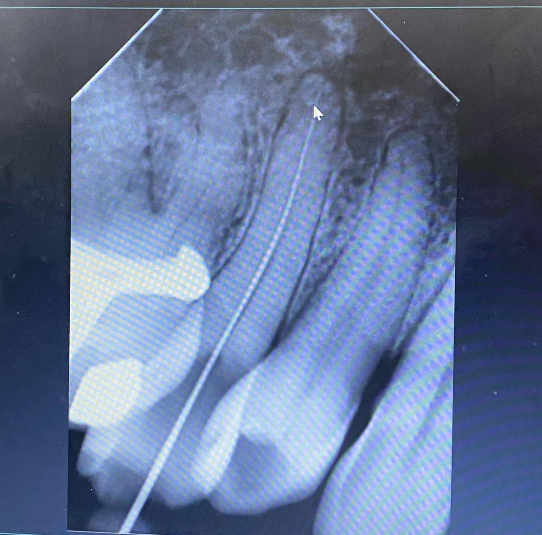 aoued_maroua's tweet image. One of my  #endo cases like  a #dentist 🦷
