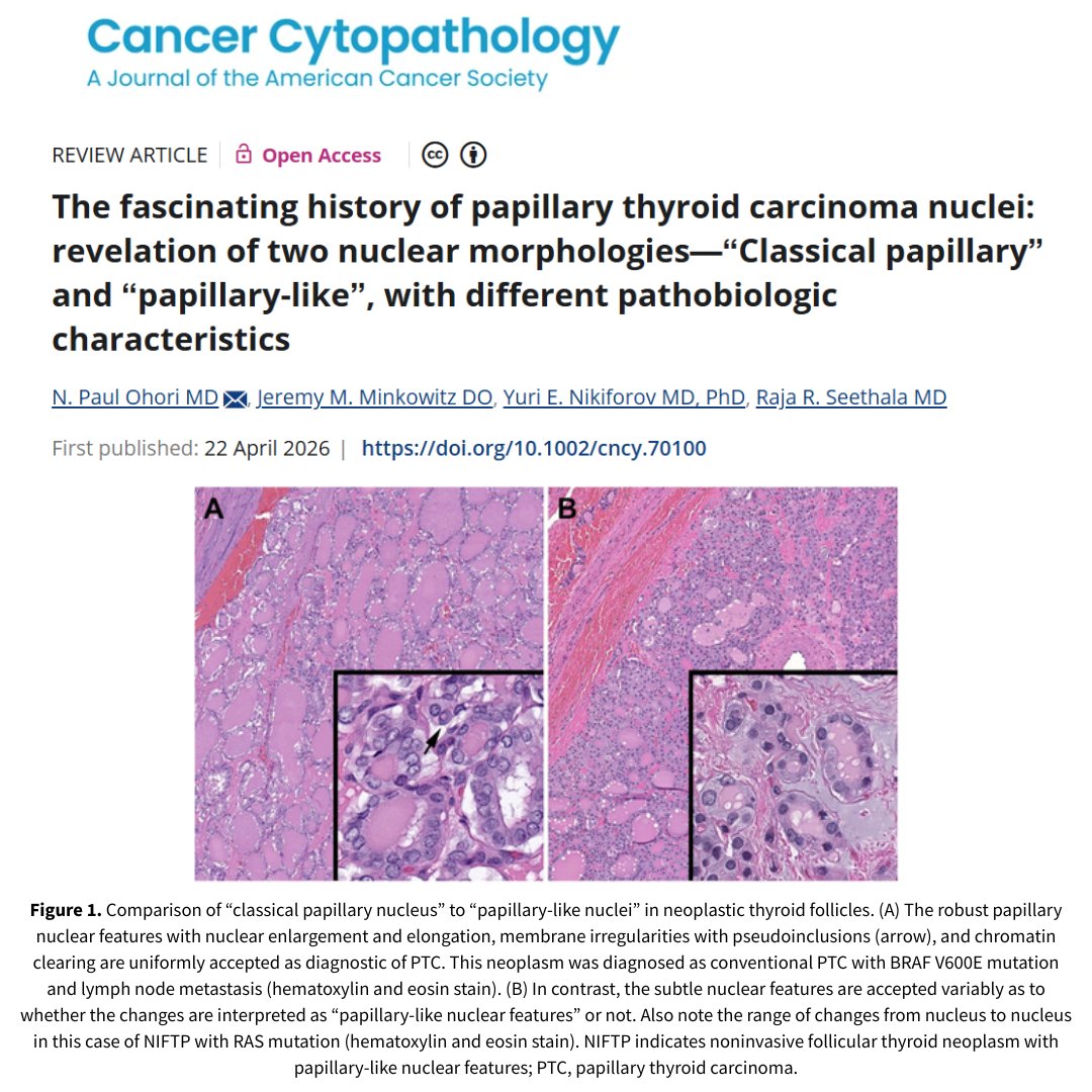 CancerCytopath's tweet image. New #OpenAccess review by N. Paul Ohori MD of @UPMCPathology et al details the fascinating history of PTC nuclei &amp;amp; summarizes the major events representing the paradigm shifts, classification system changes, and controversies: acsjournals.onlinelibrary.wiley.com/doi/full/10.10… #CytoPath #ENTPath
