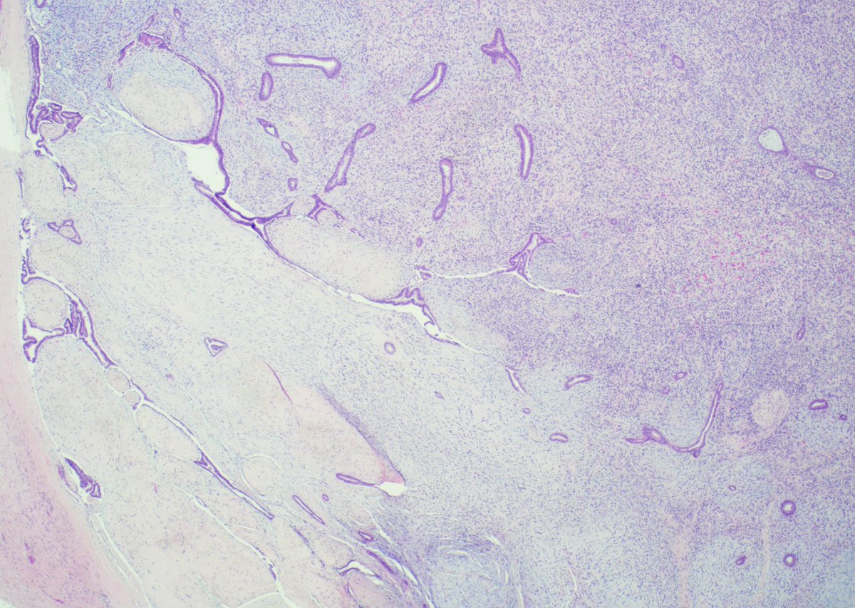 SandraIxchelS's tweet photo. Malignant phyllodes tumor with areas more consistent of “fibroadenoma” 

Sampling on limited CNB may be deceptive! Important to correlate with clinical info and mass size

#breastpathology #pathology https://t.co/5EYoebU2c0