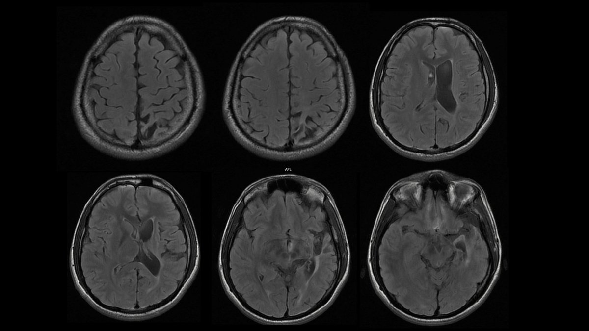 1/3 This is a 37-year-old man with a developmental history of mild motor abnormalities affecting the right side of his body. In secondary school, teachers called in his mother because the patient had academic difficulties. At age 32, he experienced an episode of #psychosis