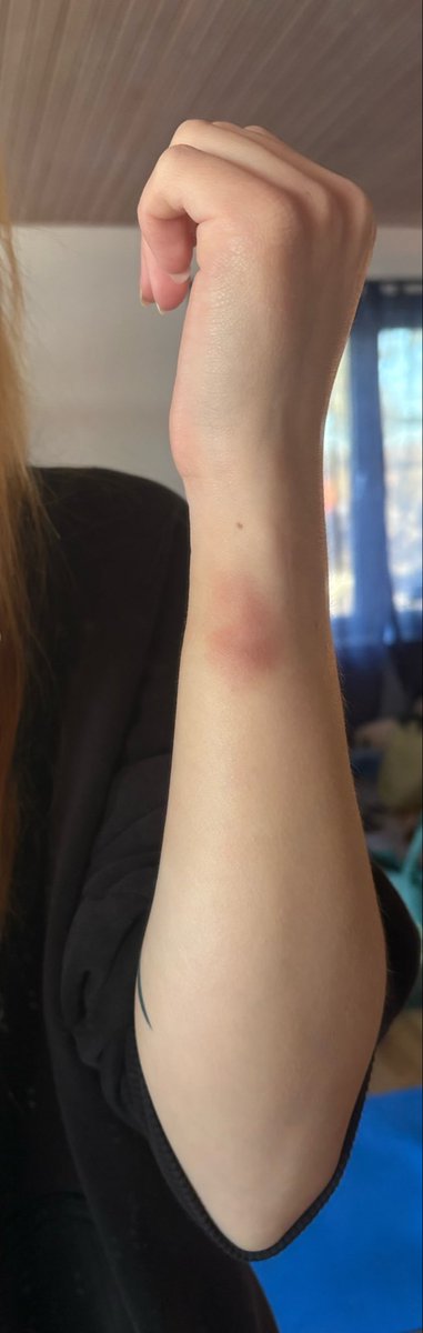 TinyTang_'s tweet photo. Anyone else bruising really easily because of their disorder?? https://t.co/jTeOxyvAUW