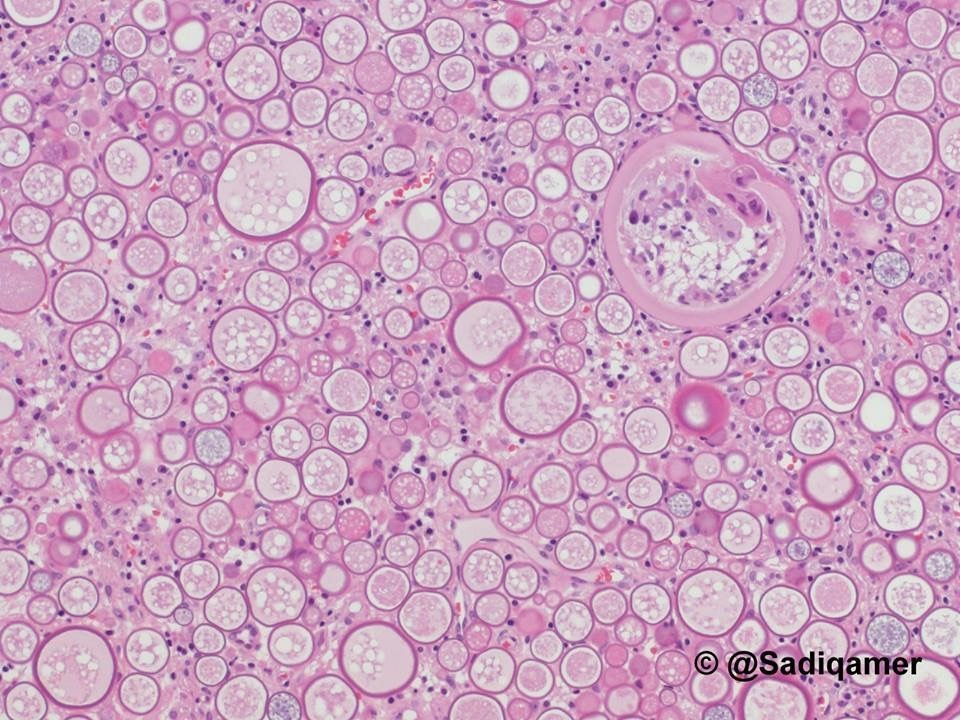 JMGardnerMD's tweet image. Nasal mucosal mass. Diagnosis? 
Answer ✅ youtu.be/aT0PaOrx8xc 
More pics &amp;amp; info: kikoxp.com/posts/5703. Many thanks to @ sadiqamer for these incredible images! 
#pathology #pathologists #pathTwitter #dermpath #dermatology #dermatologia #dermtwitter #ENTpath #microbiology