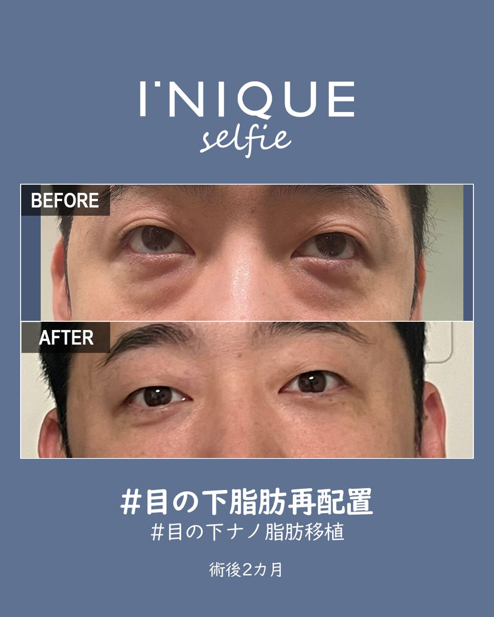 iniquejp's tweet photo. 💙 #アイニーク美容外科 症例セルフィー💙

☝手術名
#目の下脂肪再配置
#目の下ナノ脂肪移植

📌脂肪再配置で膨らみと凹みを均一にしクマ改善
📌脂肪が不足する場合はナノ脂肪移植で凹みを補う

✉️公式LINE👉https://t.co/UlALcF6I8T

#韓国整形 #渡韓整形 #症例写真 #アンコア目の下脂肪再配置 https://t.co/nWKmakIL5Y