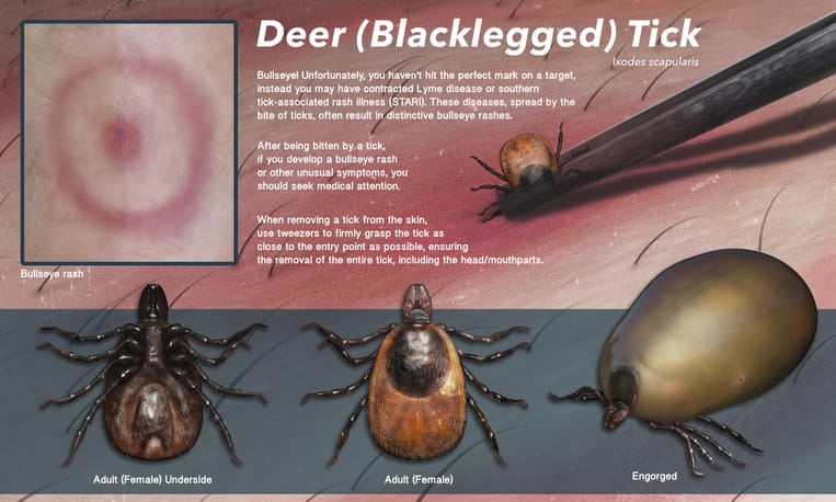 MedicalMnemonik's tweet photo. Topic: Microbiology

Subtopic: Lyme Disease

Mnemonic Type: Visual + Homophone

Mnemonic: "A Burging Red Ferrari 🚗"

Borrelia burgdorFeRI → “Burging FERrari”

Ferrari moving → Migrating erythema 🔴

Moving in circles → Bull’s-eye rash 🎯

Ixodes tick → Tick transmission 🕷️ https://t.co/ZHvLFqGoOU