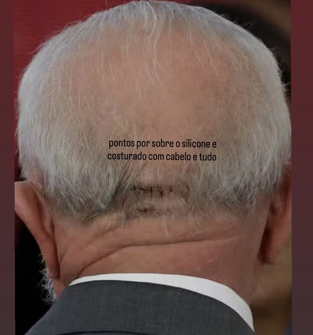 joaquimrib1801's tweet photo. Nesta sexta-feira(24), “Lula” passará por procedimentos no hospital Sírio-Libanês, em São Paulo, para retirada de queratose na cabeça e infiltração no punho por conta de uma tendinite no polegar da mão direita.
Queratose  é uma alteração da pele em que há espessamento da sua camada mais superficial, que nada mais é que acúmulo de pele( silicone) na cabeça.