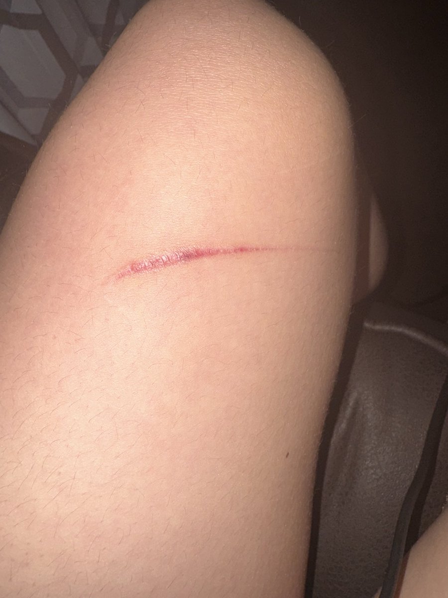 Lilyyyyznzf's tweet image. It's finally #healing 😝(ignore my hairy ass legs)