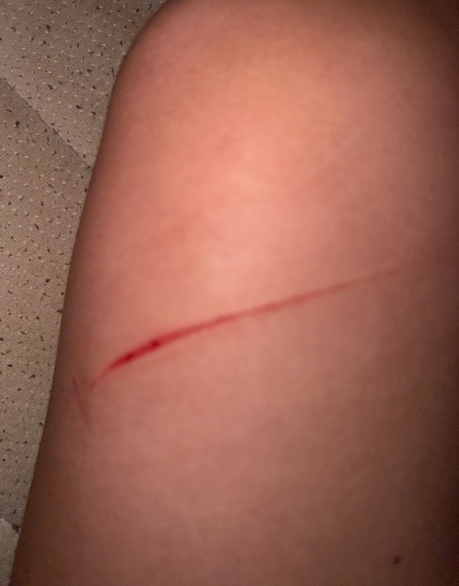 Lilyyyyznzf's tweet image. It's finally #healing 😝(ignore my hairy ass legs)