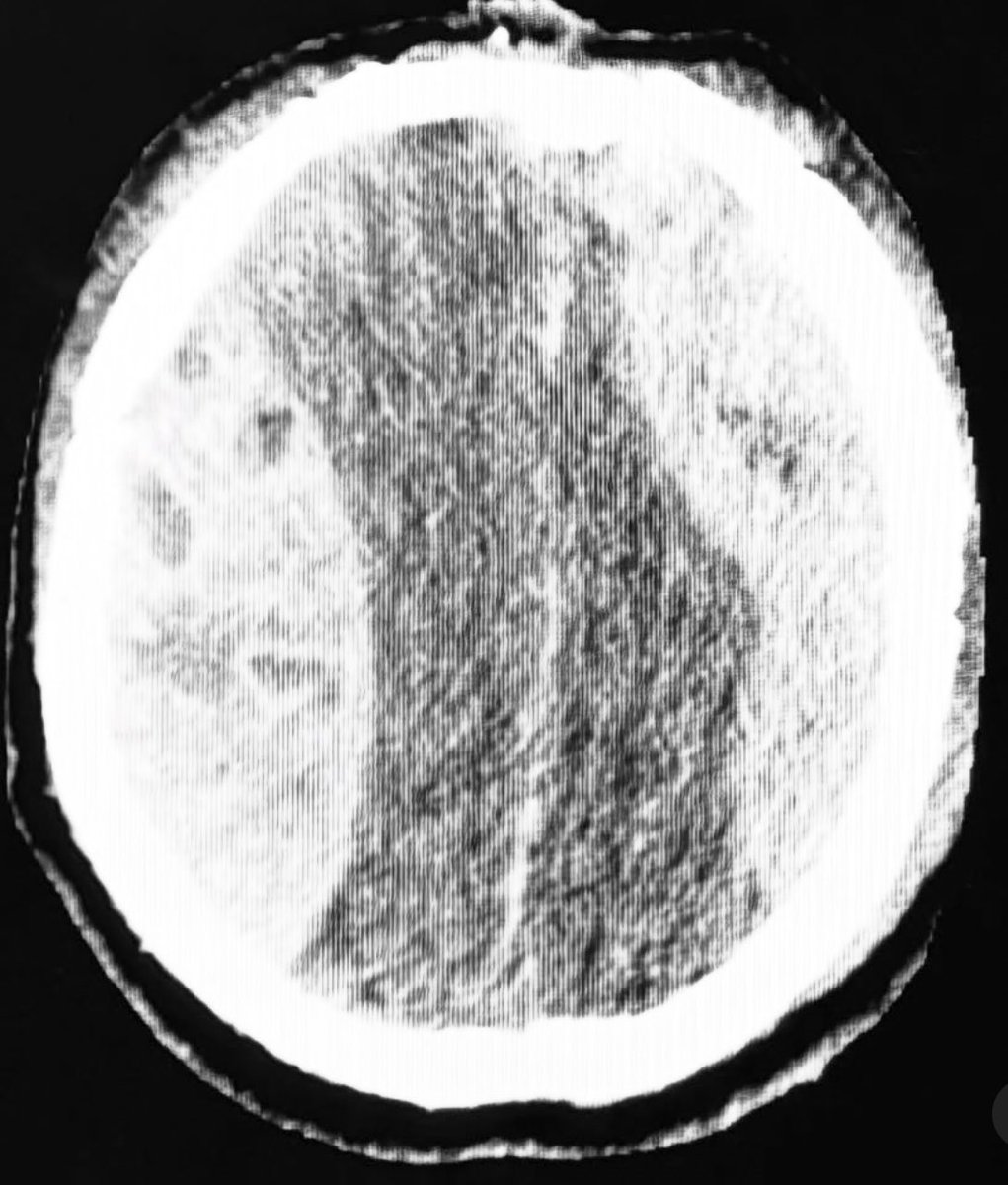 Which side are you taking out first?