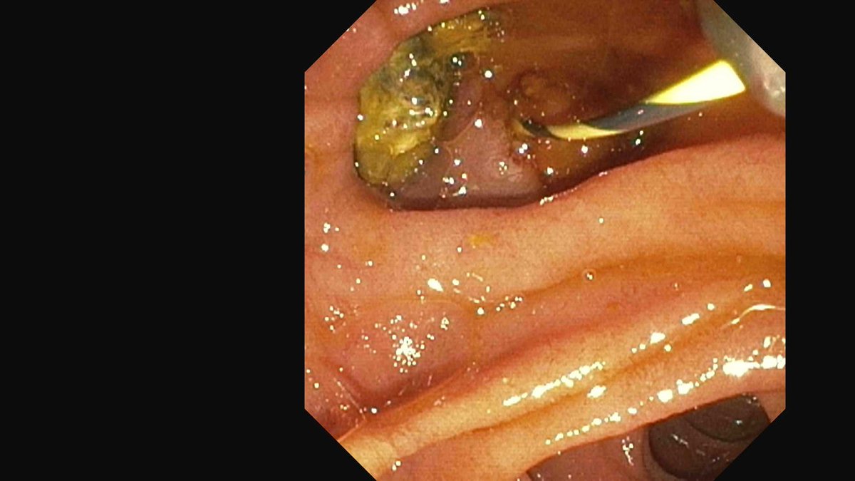 DouglasAdlerMD's tweet image. Don't be afraid to EXTEND a prior sphincterotomy if you feel it is inadequate. 

This pt had a 25mm stone and a decent prior sphincterotomy. Extended and completed and stone removed with a balloon sweep during ERCP. 

#gitwitter #surgery #medx #medtwitter