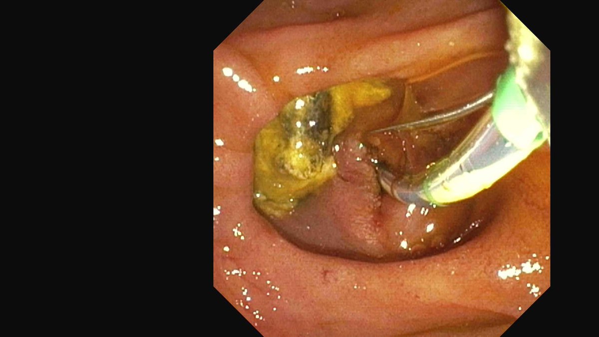 DouglasAdlerMD's tweet image. Don't be afraid to EXTEND a prior sphincterotomy if you feel it is inadequate. 

This pt had a 25mm stone and a decent prior sphincterotomy. Extended and completed and stone removed with a balloon sweep during ERCP. 

#gitwitter #surgery #medx #medtwitter