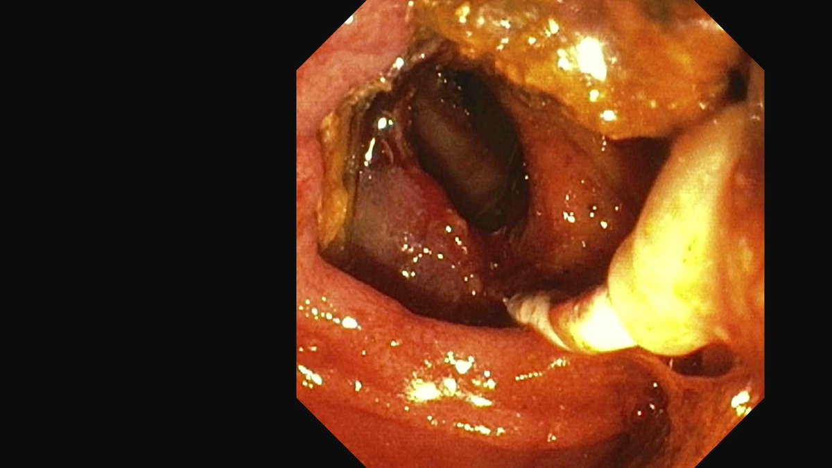 DouglasAdlerMD's tweet image. Don't be afraid to EXTEND a prior sphincterotomy if you feel it is inadequate. 

This pt had a 25mm stone and a decent prior sphincterotomy. Extended and completed and stone removed with a balloon sweep during ERCP. 

#gitwitter #surgery #medx #medtwitter